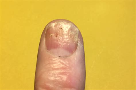 Psoriasis in the fingernails and toenails