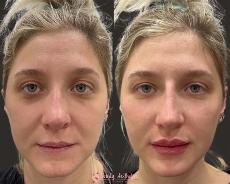 Juvederm Cheeks Before And After Photos