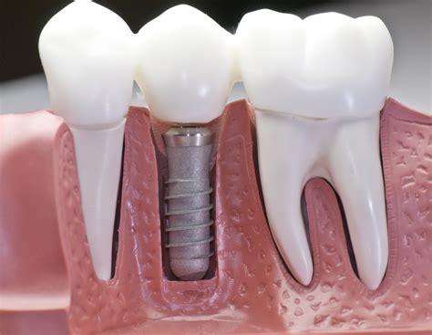 Dental Implants: What You Should Know - Sri Aakrithis Dental Lounge And ...