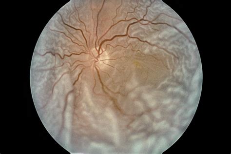 Widefield OCT Shows Effects of Rhegmatogenous Retinal Detachment ...