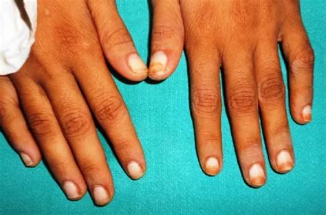 4 Ways HIV May Affect Your Nails | myHIVteam