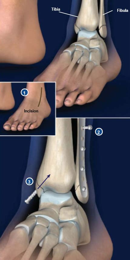 Ankle Fracture Surgery | Central Coast Orthopedic Medical Group