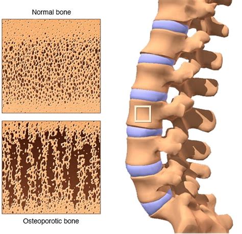 Bone Density Test - Scan Preparation, Cost, Results