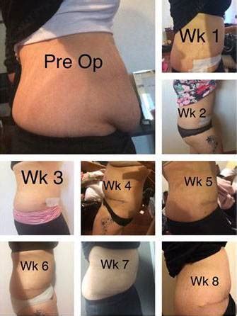 Tummy tuck before and after pics and image » Tummy Tuck: Prices, Photos ...