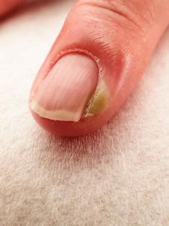 Cuticle Infection | LoveToKnow Health & Wellness