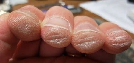 How to Build Guitar Calluses: Take Care of Your Fingers!