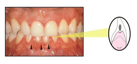 Gum Pain Between Teeth: Potential Causes & Instant Relieve