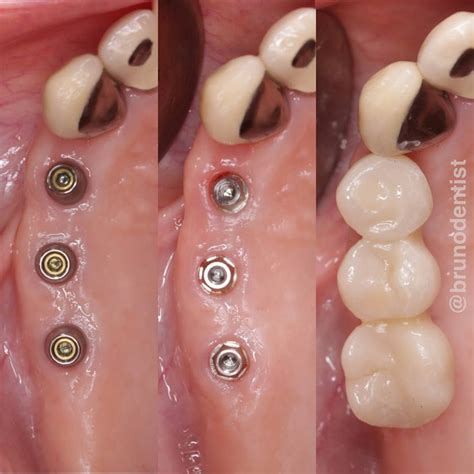 Screw retained bridge made on micro abutments. #dentalimplants # ...