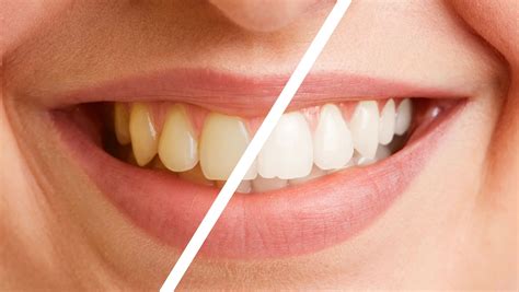 Deep Teeth Cleaning: Before and After - Dental Health Society