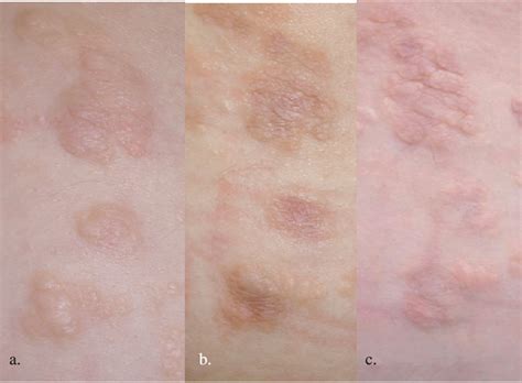 Figure 1 from Histologic resolution of naevus lipomatosus superficialis ...