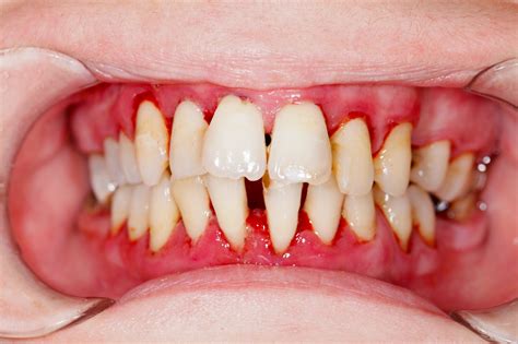 4 Telltale Signs of Gum Disease - Balsall Common Dental