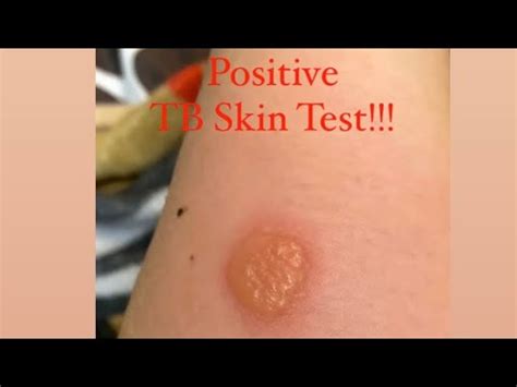 POSITIVE TB SKIN TEST!!! - YouTube