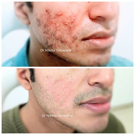 Acne Treatment In Mumbai - Cost, Before After, Laser, Acne Specialist