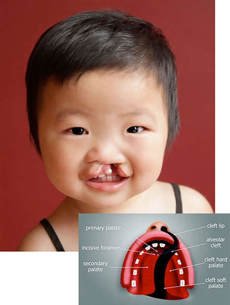 Cleft Lip and Palate – Orthodontics Dental Treatment