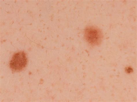 Melanoma pictures by stages, stage 0-1-2-3-4 melanoma pictures ...