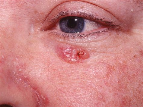 Basal Cell Carcinoma Causes Types Symptoms Prognosis Treatment – NBKomputer