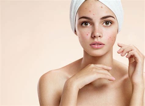 Acne Scarring Treatment - Laser Skin Solutions