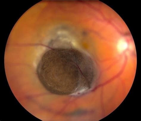 Choroidal Melanoma Anterior - Retina Image Bank