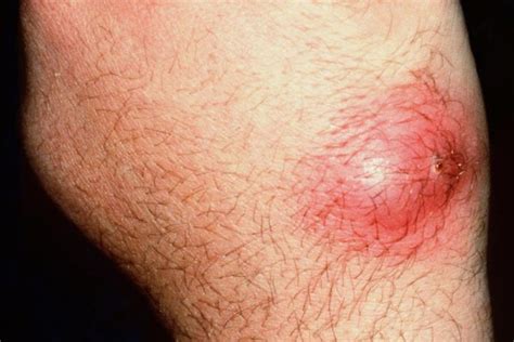 A boil on the back of the hand Cellulitis Infection, Fungal Infection ...