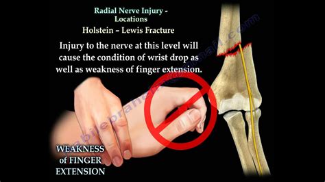 Radial Nerve Injury, Locations - Everything You Need To Know - Dr ...