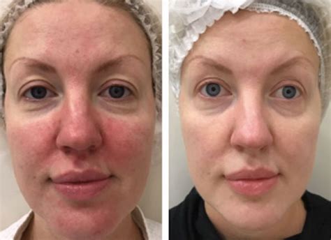 Rosacea | Advanced Dermatology & Cosmetic Surgery Center