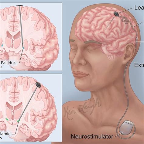 Myocutaneous Gracilis Flap Procedure Illustration by Keri Leigh ...