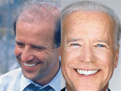 Joe Biden Old School Hair Plugs and Hair Loss Story