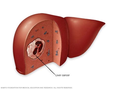 What Causes Liver Cancer In Young Adults - CancerWalls