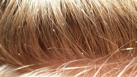 Head Lice: What You Need To Know – Knoxville Institute of Dermatology