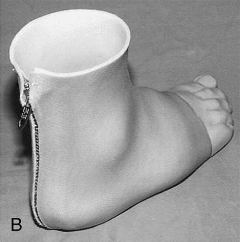 Orthotic and prosthetic devices in partial foot amputations - Foot and ...