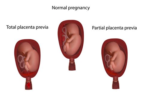 Antepartum Hemorrhage - What is It, Top Causes and Complications ...