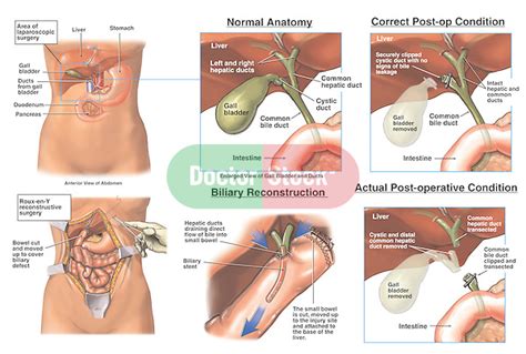 Laparoscopic Cholecystectomy Procedure with Subsequent Bile Duct Injury ...