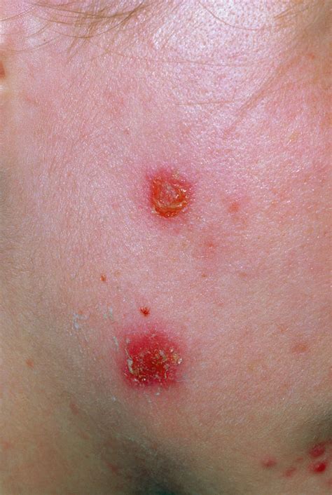 Impetigo Rash On Neck