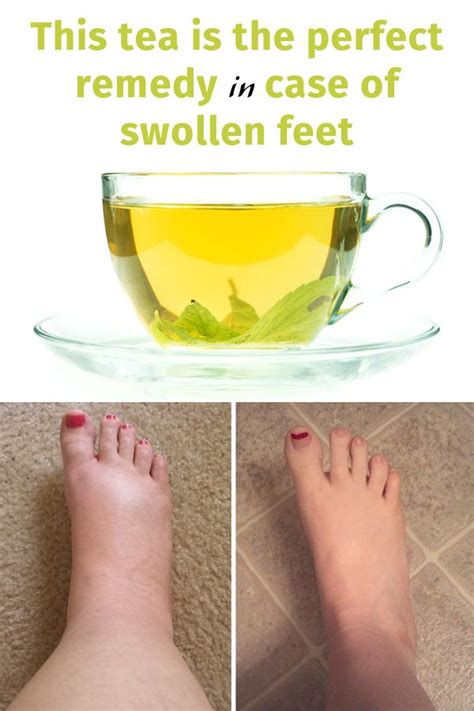 swollen feet after delivery symptoms - Sena Conley