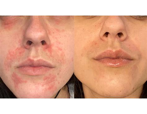 Effective Perioral Dermatitis Treatments Brisbane - Cutis Dermatology