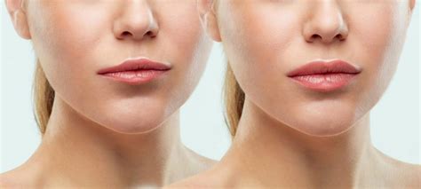 Lip Flip with Botox in Kansas City - Mirabile M.D. - mirabilemd.com