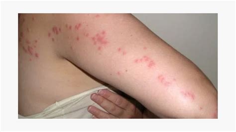 What Do Bedbug Bites Look Like On Dogs