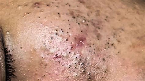 Newest Blackhead Removal Videos July 2024 - Mina Suzann