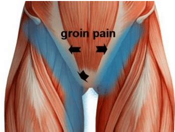 Inguinal Ligament Pain