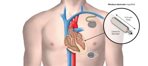 On the road to a leadless, wireless pacemaker | MobiHealthNews