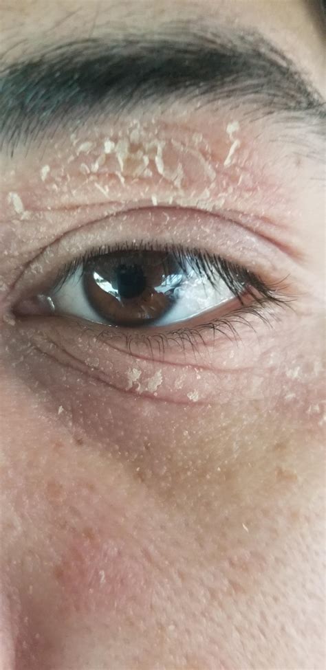 Eczema around my eye. : r/peeling