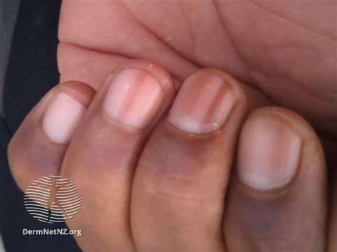 4 Ways HIV May Affect Your Nails | myHIVteam