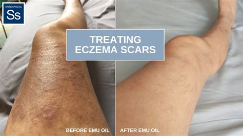 How to Lighten Eczema Scars and Prevent Further Skin Aging ...