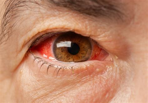 Red Eyes: Symptoms, Causes, and Treatments