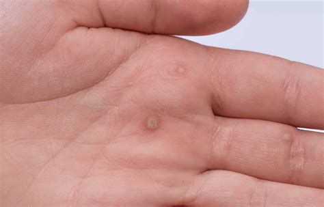 Answers to Frequently Asked Questions About Warts - Health Tenfold