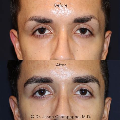 Male Eyebrow Hair Transplant — Plastic Surgeon Beverly Hills, CA | Dr ...