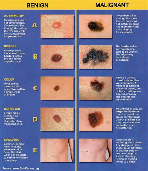 Dr. Visha Blog: The ABCDE of Melanoma