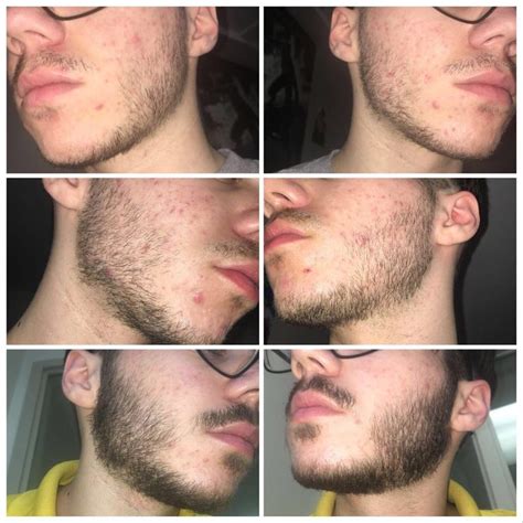 18 y/o. Was told I can’t grow a beard and started using minoxidil. Top ...