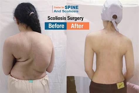 Best treatment for Scoliosis at the Center Spine India - Dr Hitesh Garg