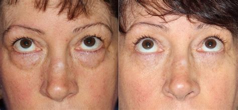 lower eyelid lift Cheaper Than Retail Price> Buy Clothing, Accessories ...